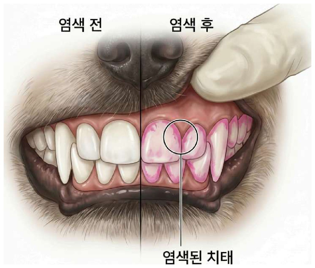 치태 염색 전후 비교 — 염색된 치태가 드러난 모습